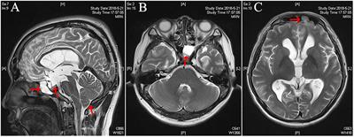 Successful Treatment of Spontaneous Cerebrospinal Fluid Rhinorrhea With Endoscopic Third Ventriculostomy and Lumboperitoneal Shunt: A Case Report